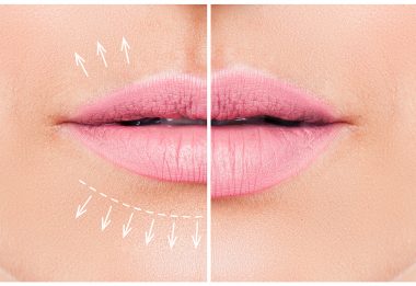 fillers before and after